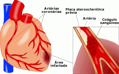 Síntomas de infarto de miocardio
